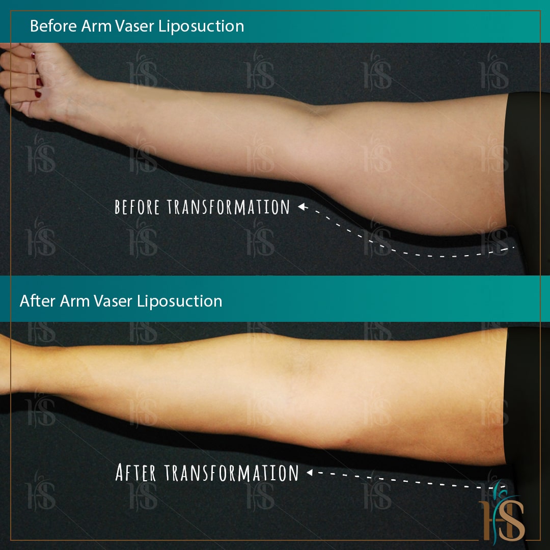 vaser liposuction arms - Before After Image - Hasan Surgery