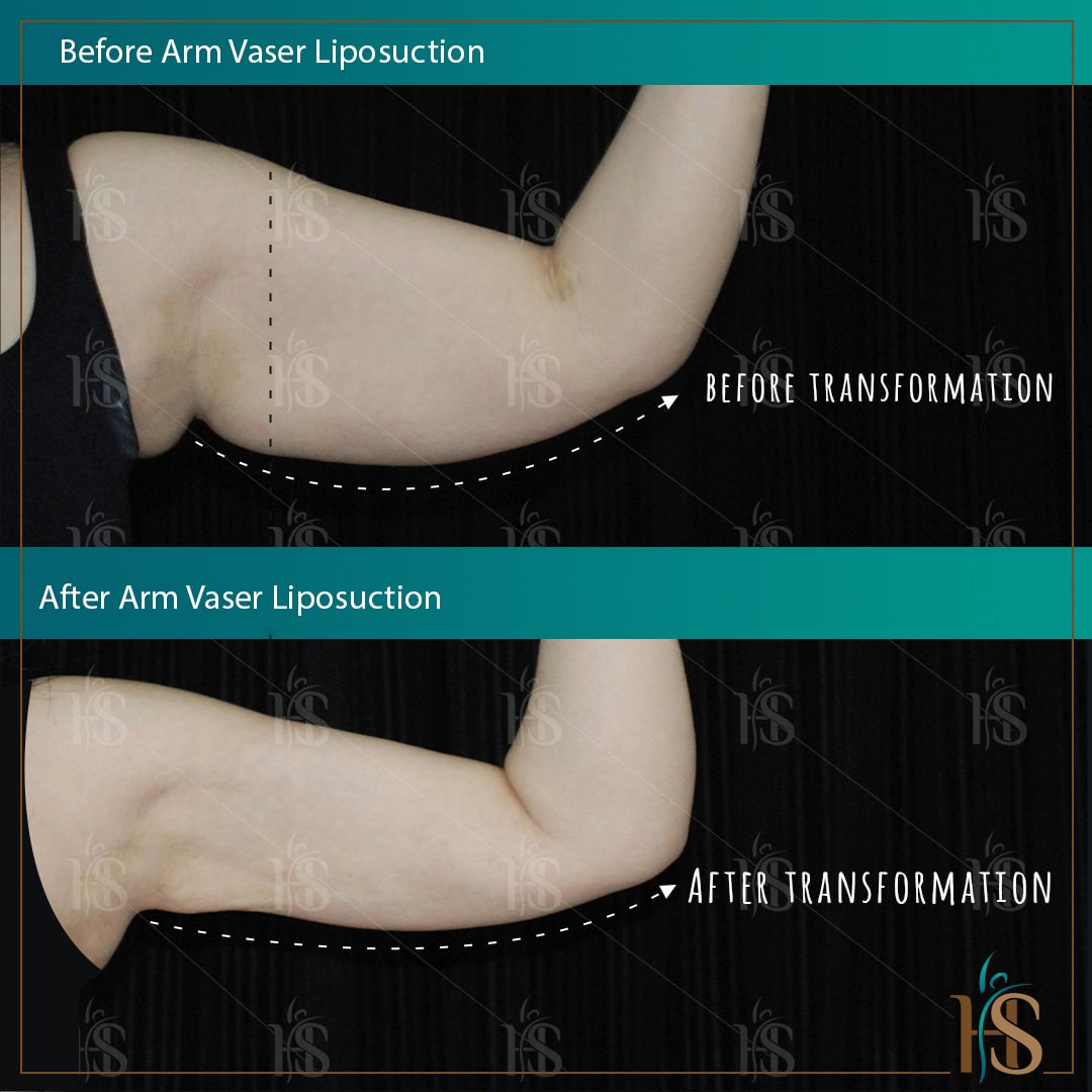 vaser liposuction of arms - @ Hasan Surgery - Top plastic surgery clinic in London