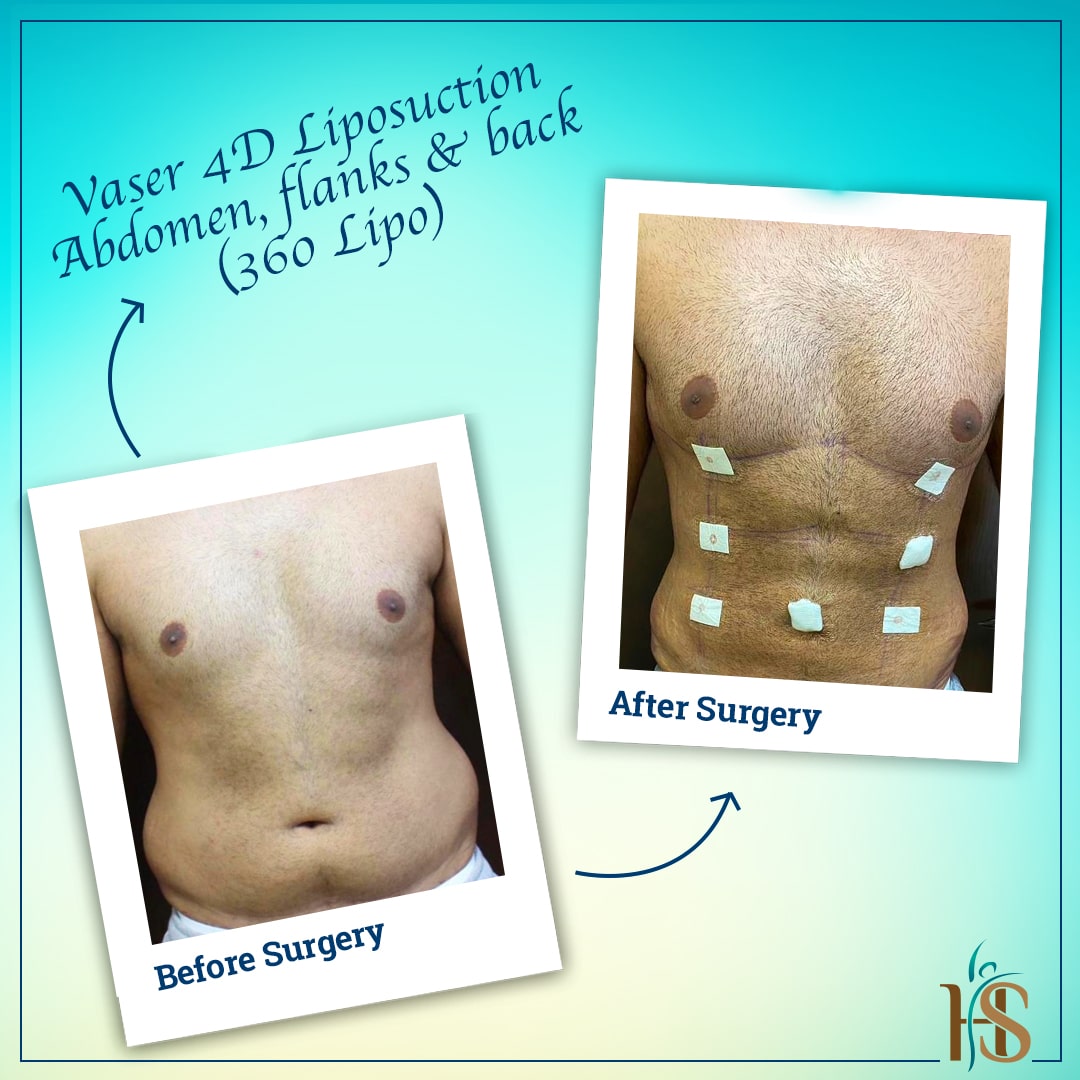 4d hi def vaser liposuction london - Hasan Surgery