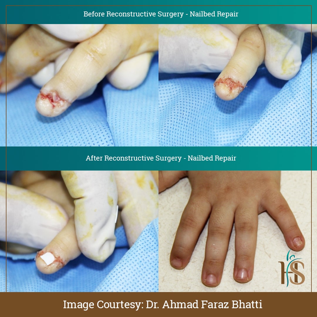 nailbed repair with best reconstructive surgeon in london uk