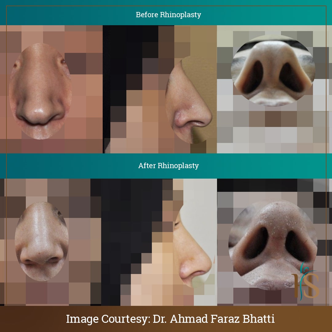 rhinoplasty london before after