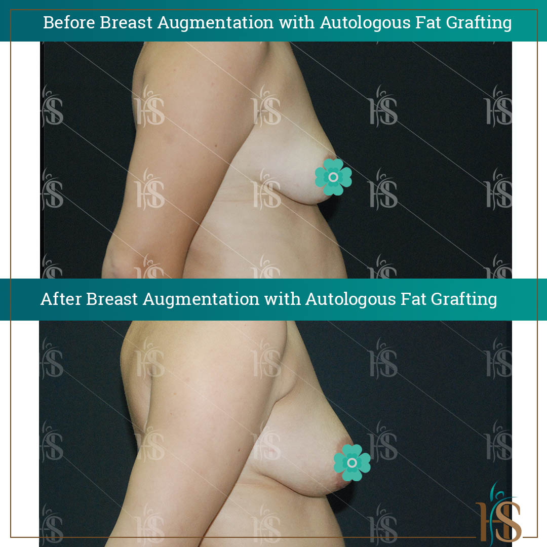 breast augmentation via fat transfer london uk