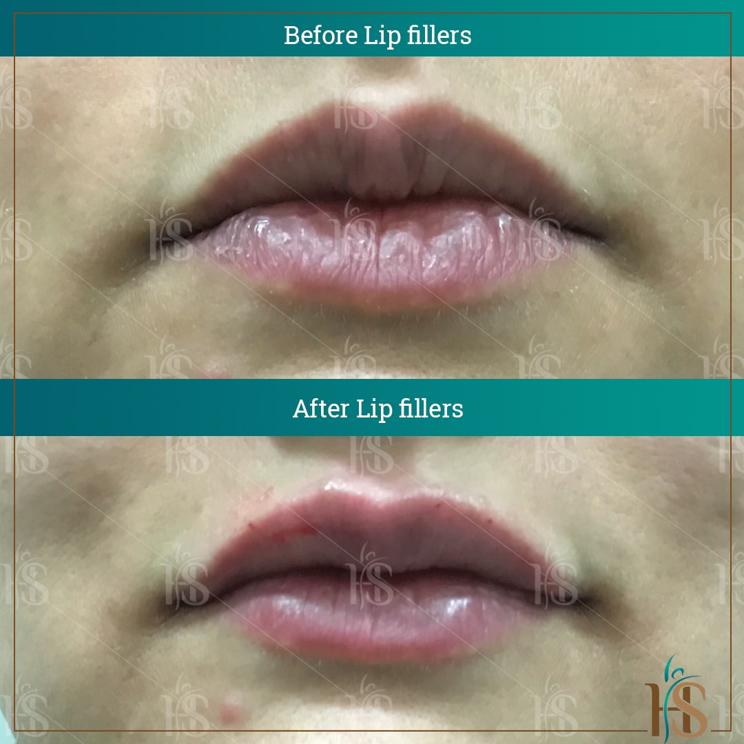 lip fillers london before after
