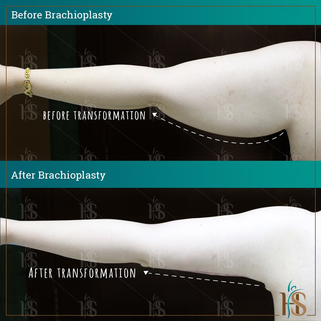 Arm Lift Surgery in Dubai - by Hasan Surgery - top plastic surgery clinic in Dubai