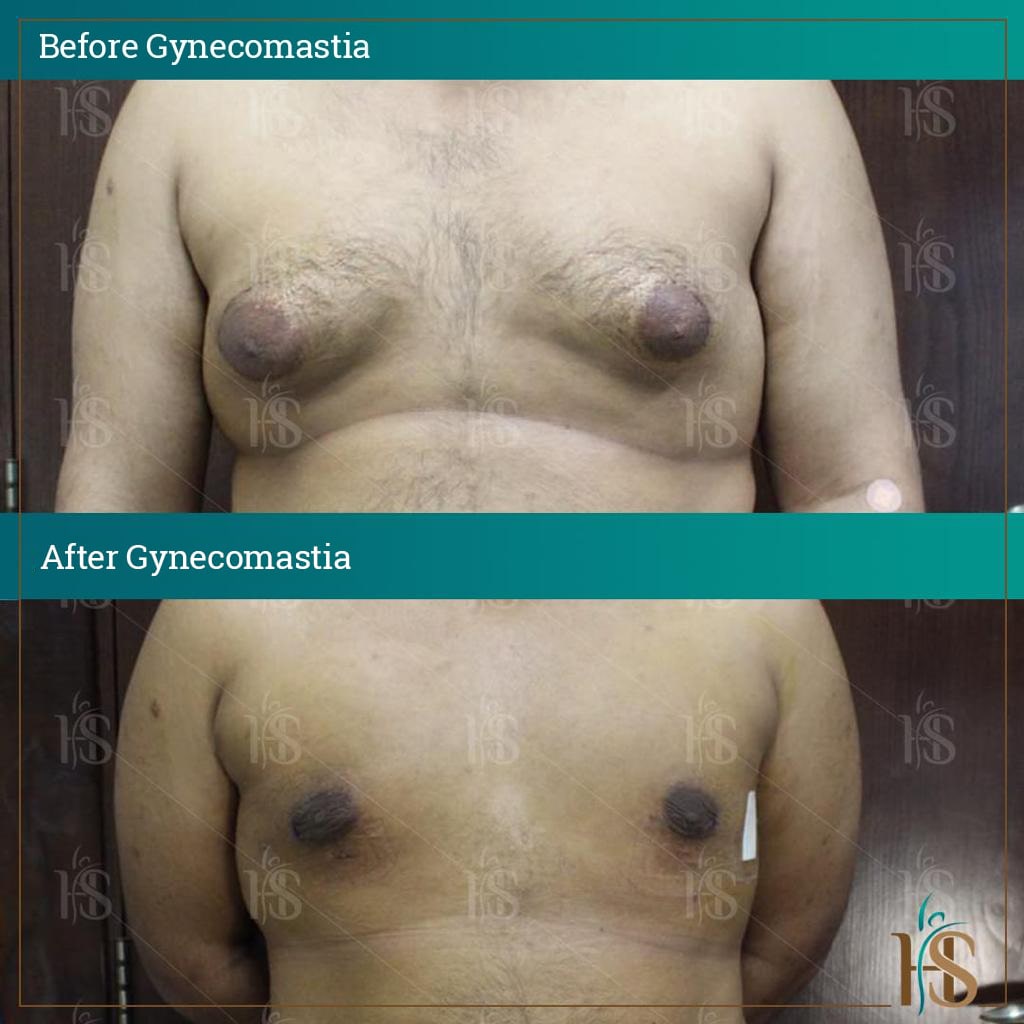 gynecomastia surgery dubai