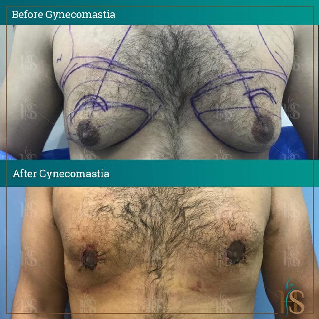 male breast reduction surgery dubai before after
