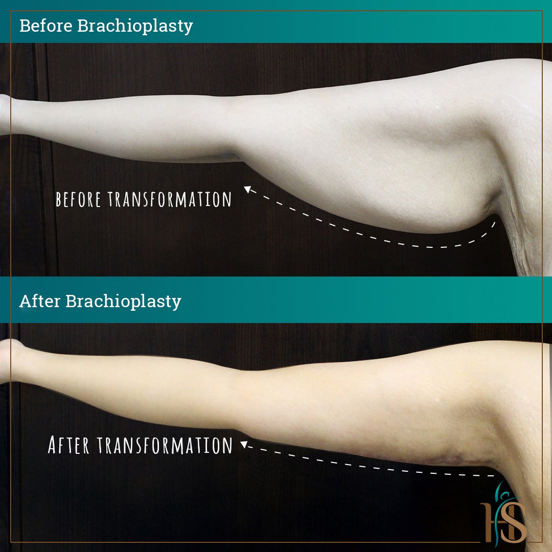 brachioplasty in dubai - before after - by Hasan Surgery