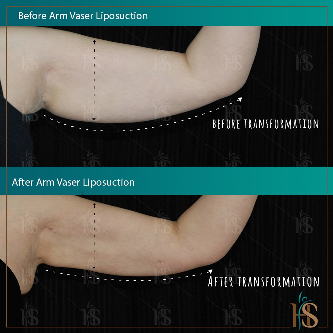 arm vaser liposuction dubai - @ Hasan Surgery - Best plastic surgery clinic in UAE