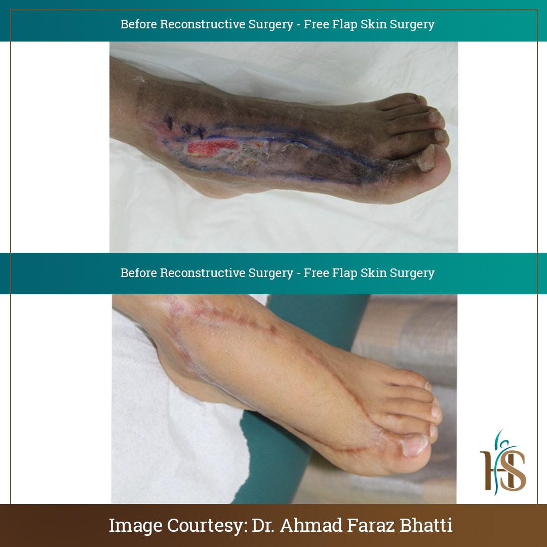free flap skin surgery dubai