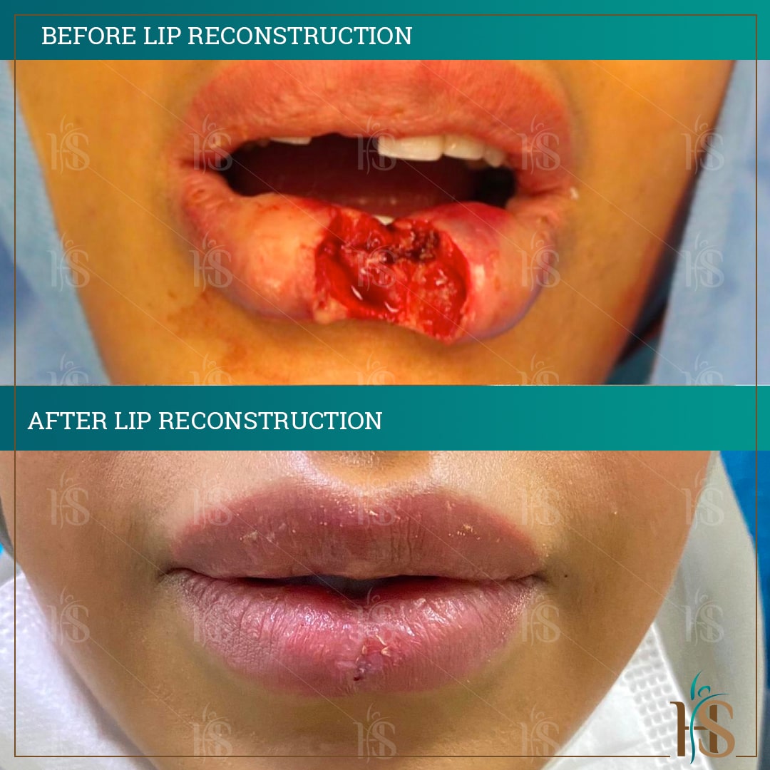 reconstructive skin surgery - lip reconstructive - @ Hasan Surgery Dubai