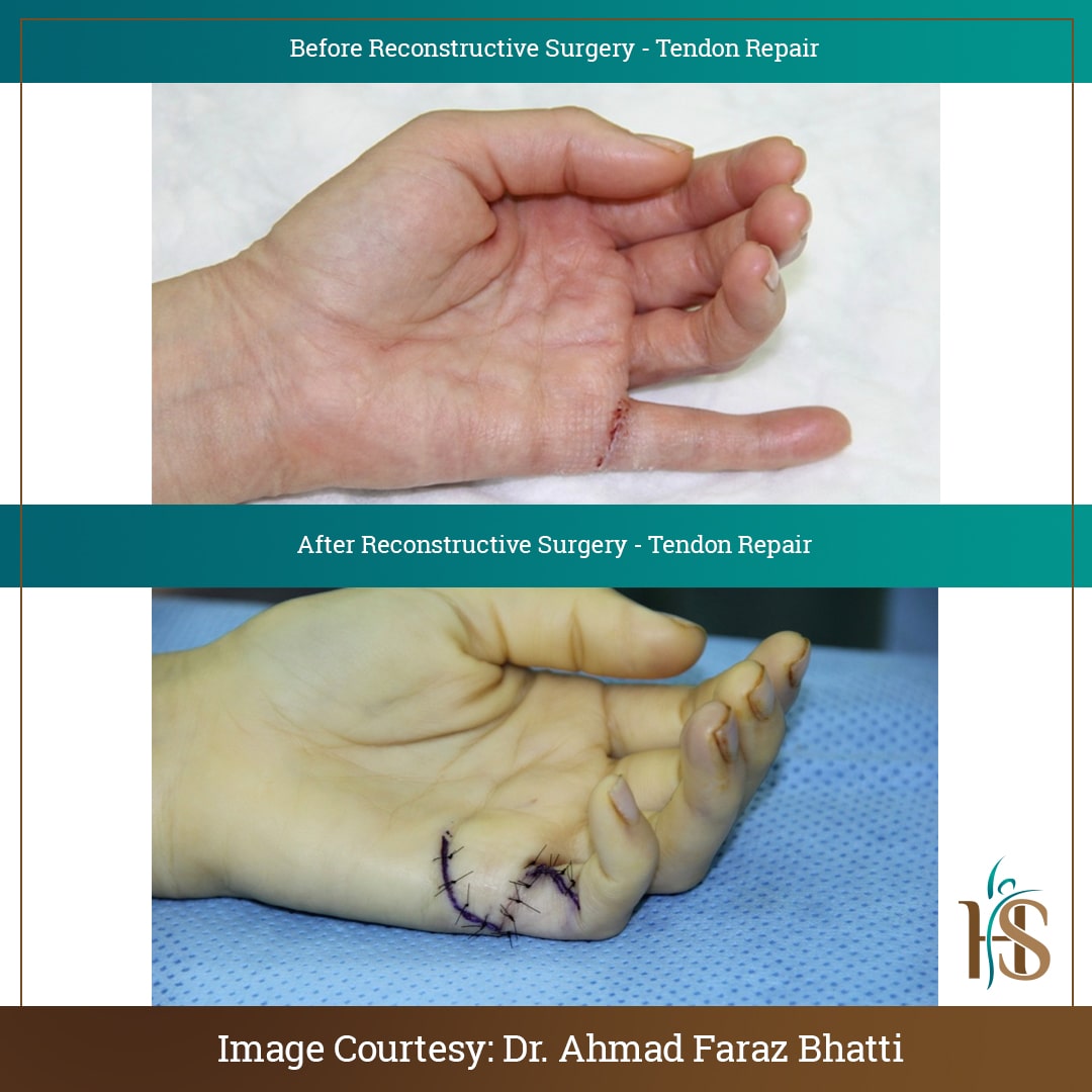 tendon repair reconstructive surgery dubai