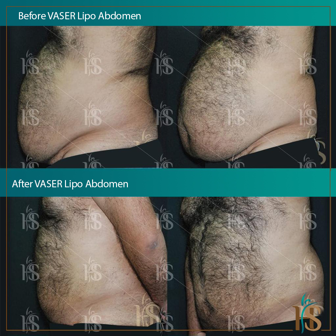 vaser liposuction abdomen