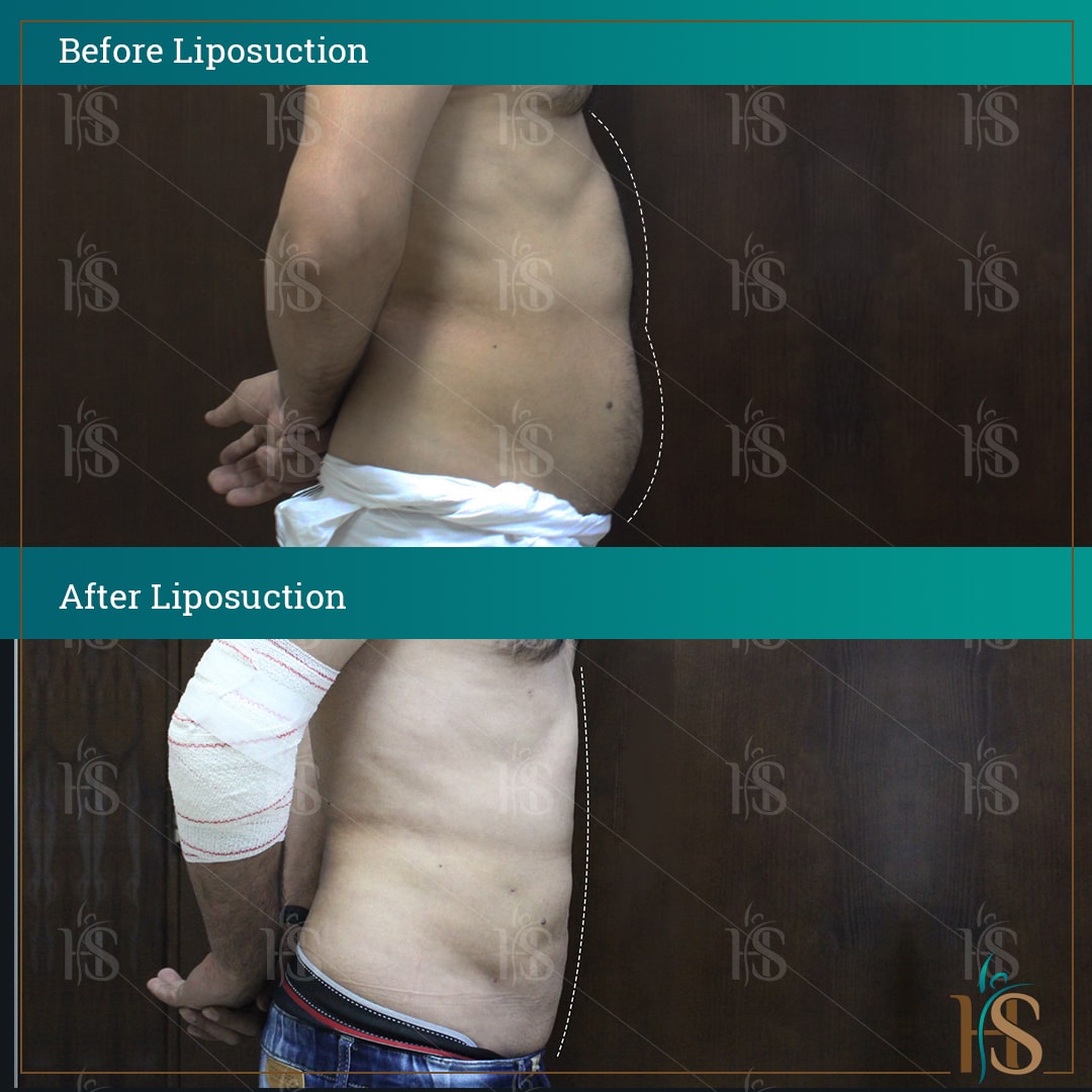stomach vaser liposuction in dubai - before after