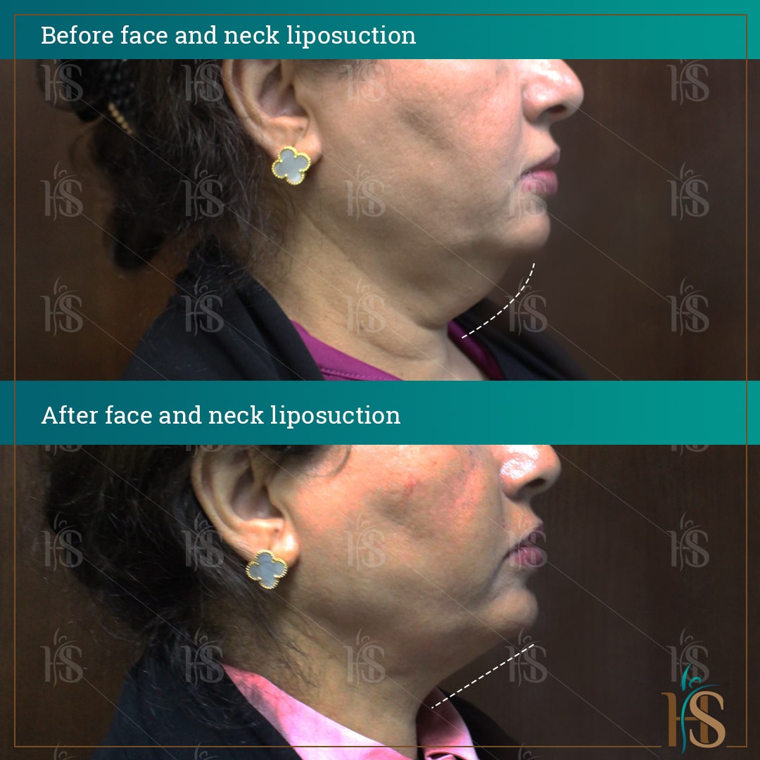 face and neck vaser liposuction in dubai