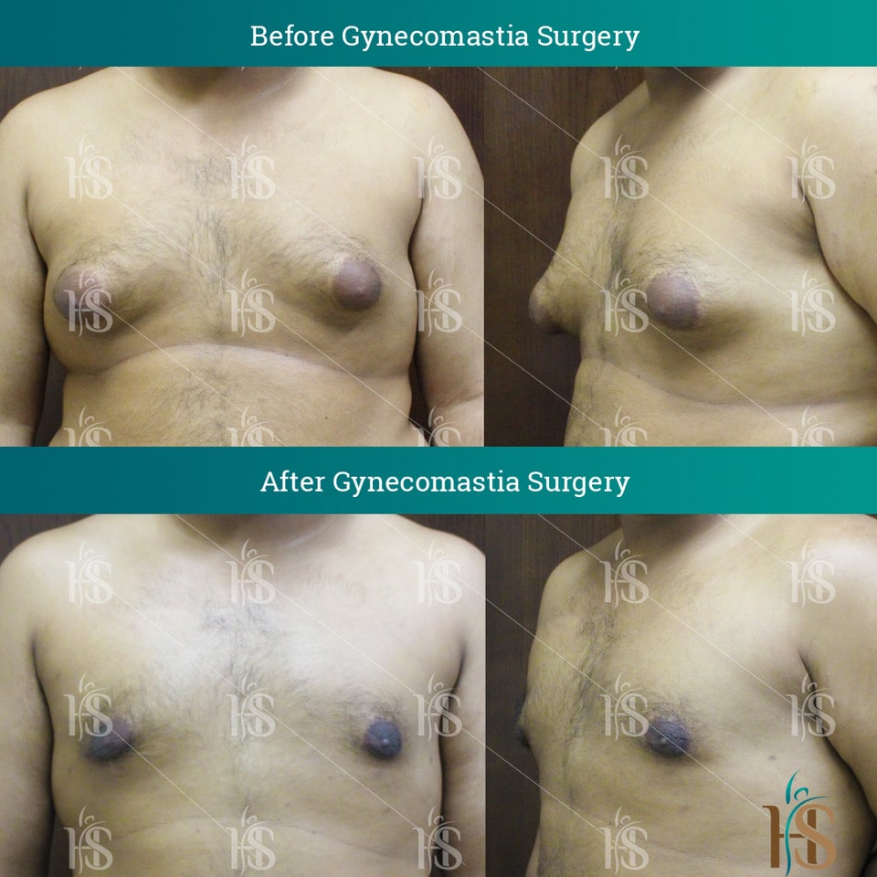Gynecomastia Surgery in Dubai @ Hasan Surgery