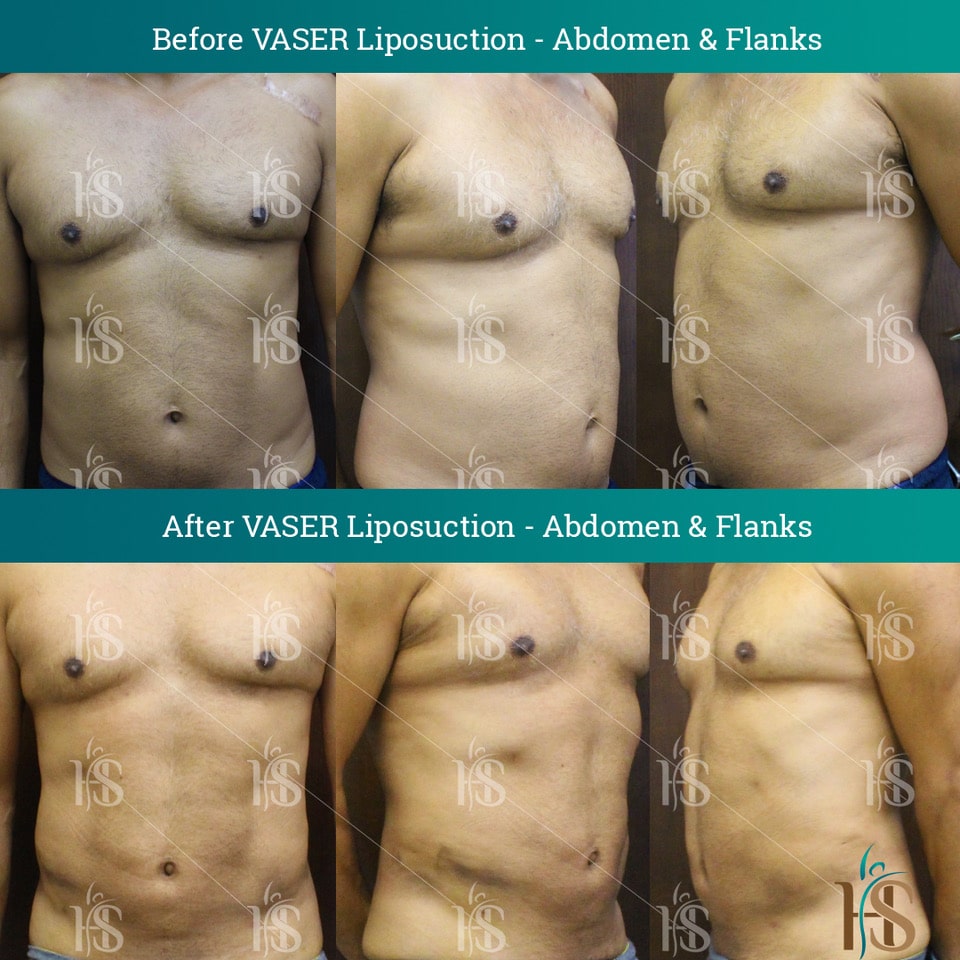 VASER Lipo Before After - Hasan Surgery