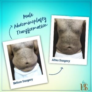 Male Abdominoplasty in Dubai - Before After - Hasan Surgery