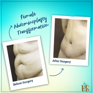 Female Abdominoplasty in Dubai - Before After - Hasan Surgery