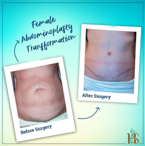 Tummy Tuck in Dubai - Before After - Hasan Surgery