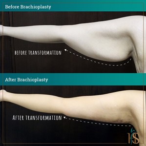 brachioplasty in dubai - before after - Hasan Surgery