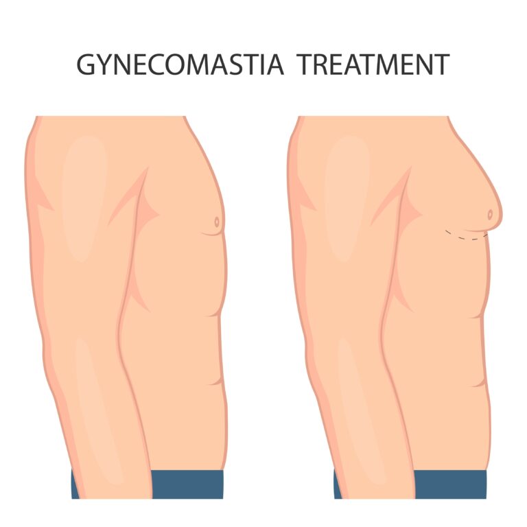 gynecomastia surgery recovery