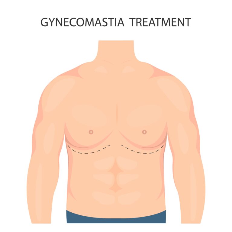 what is gynecomastia surgery