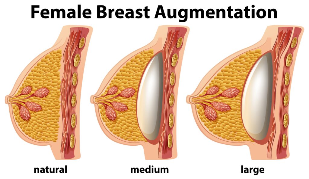 breast augmentation fat transfer after 5 years - Hasan Surgery