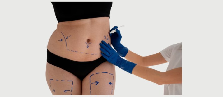 Tummy Tuck Recovery: What Should I Expect?
