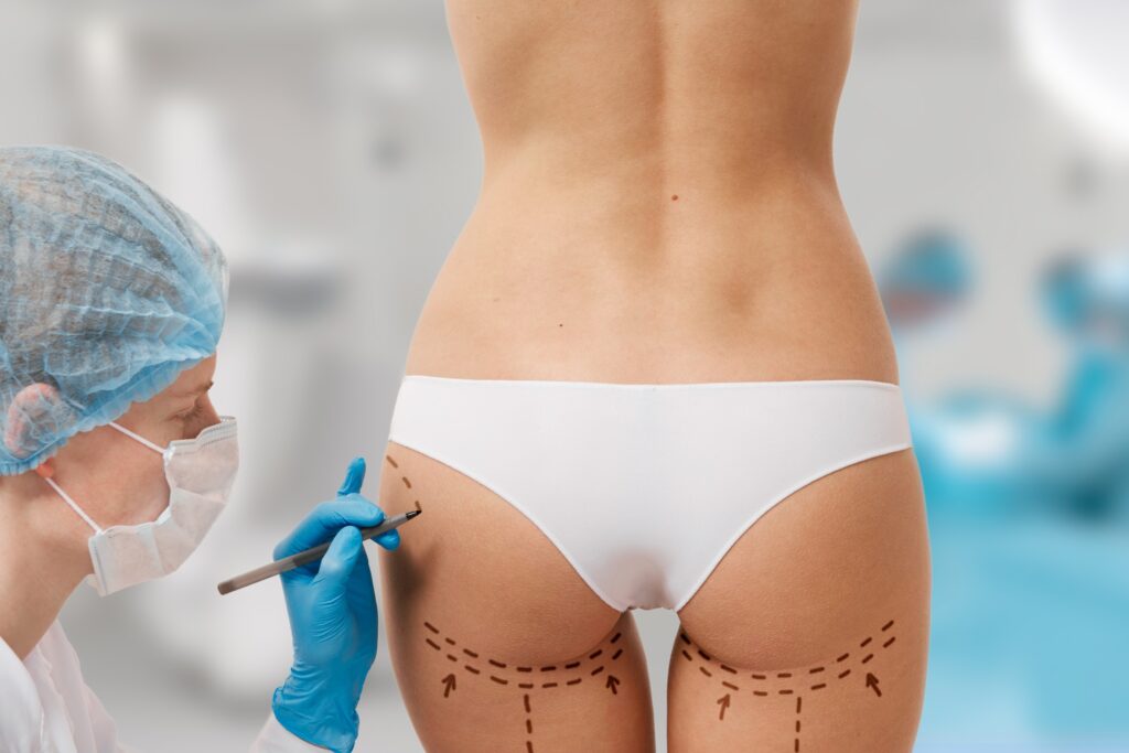 How Does A Brazilian Butt Lift Work? - Hasan Surgery - Plastic Surgery Clinic in Dubai