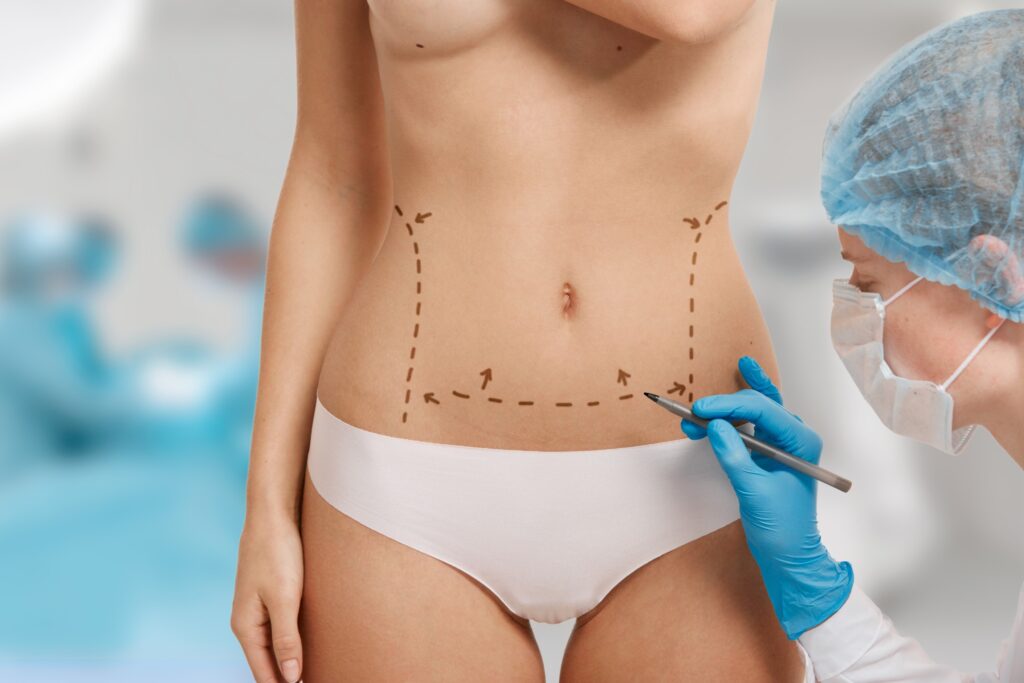 tummy tuck recovery timeline - hasan surgery
