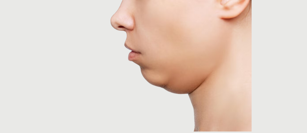 How to Get Rid of Double Chin - Hasan Surgery