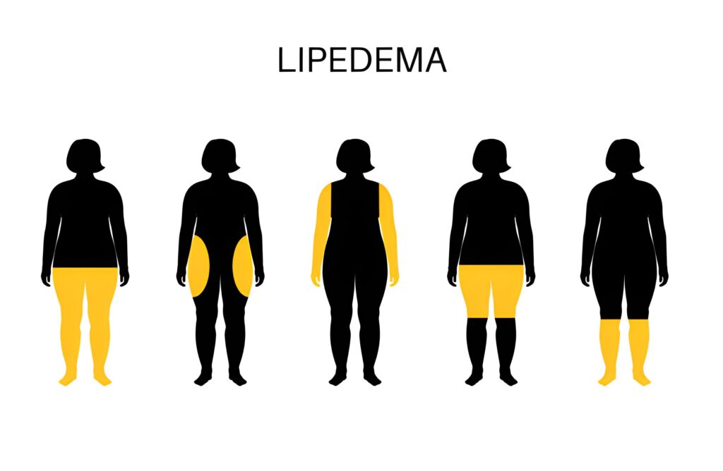Lipedema Treatment - Hasan Surgery