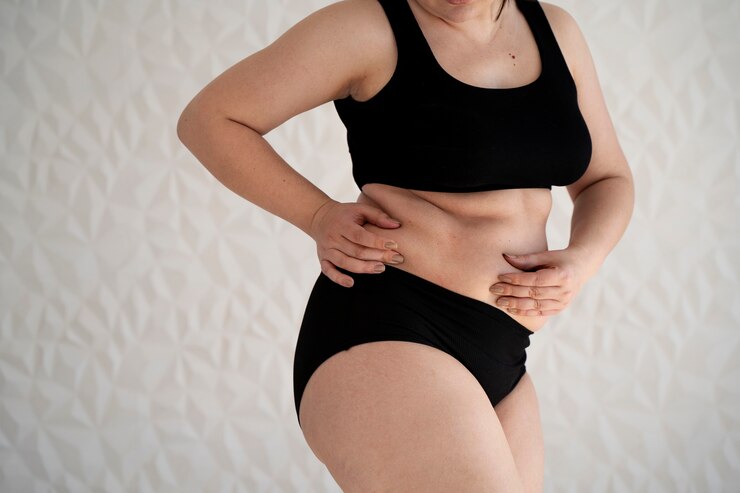 General Timeline for Exercises After Liposuction