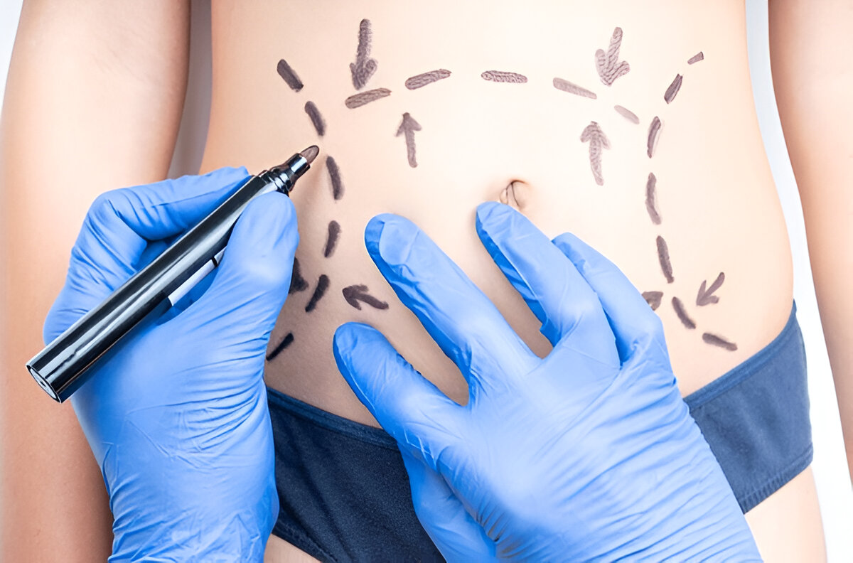 panniculectomy vs tummy tuck