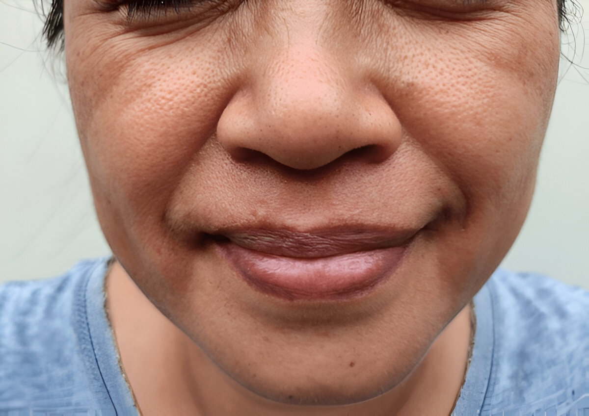 Droopy mouth marionette lines filler gone wrong