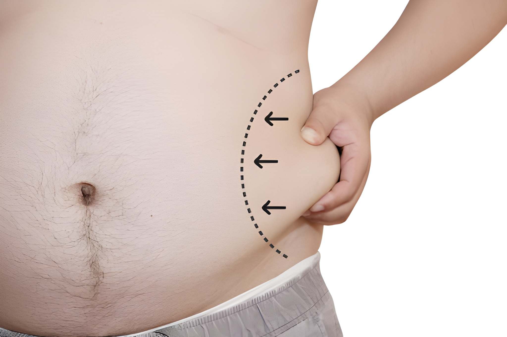 Does fat come back after liposuction