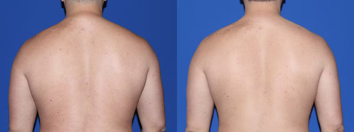 what is a buffalo hump