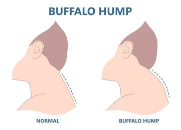 buffalo hump neck