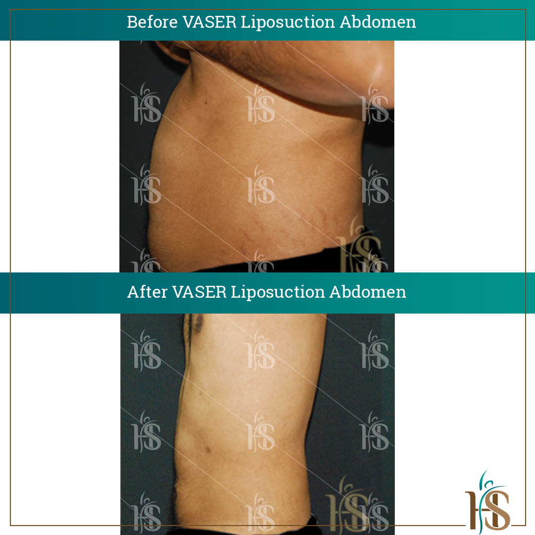 VASER-Liposuction-Abdomen-3