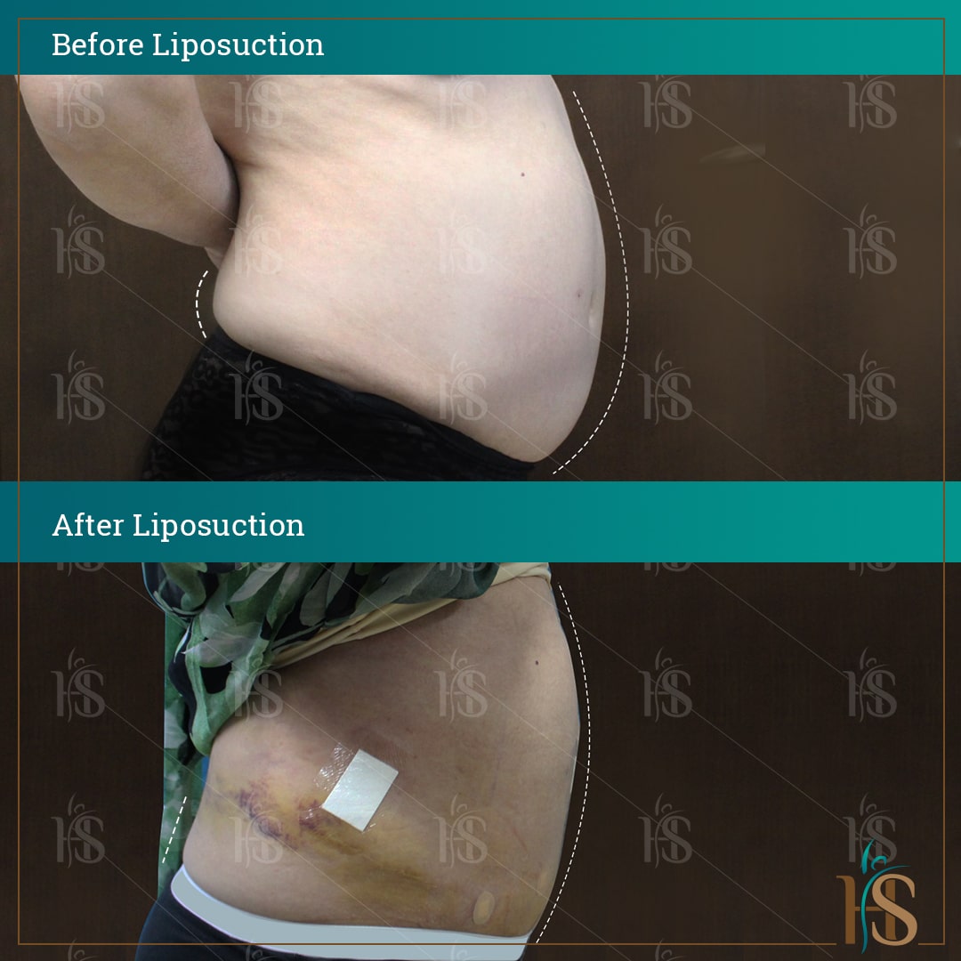 before-and-after-LIPOSUCTION11308-min